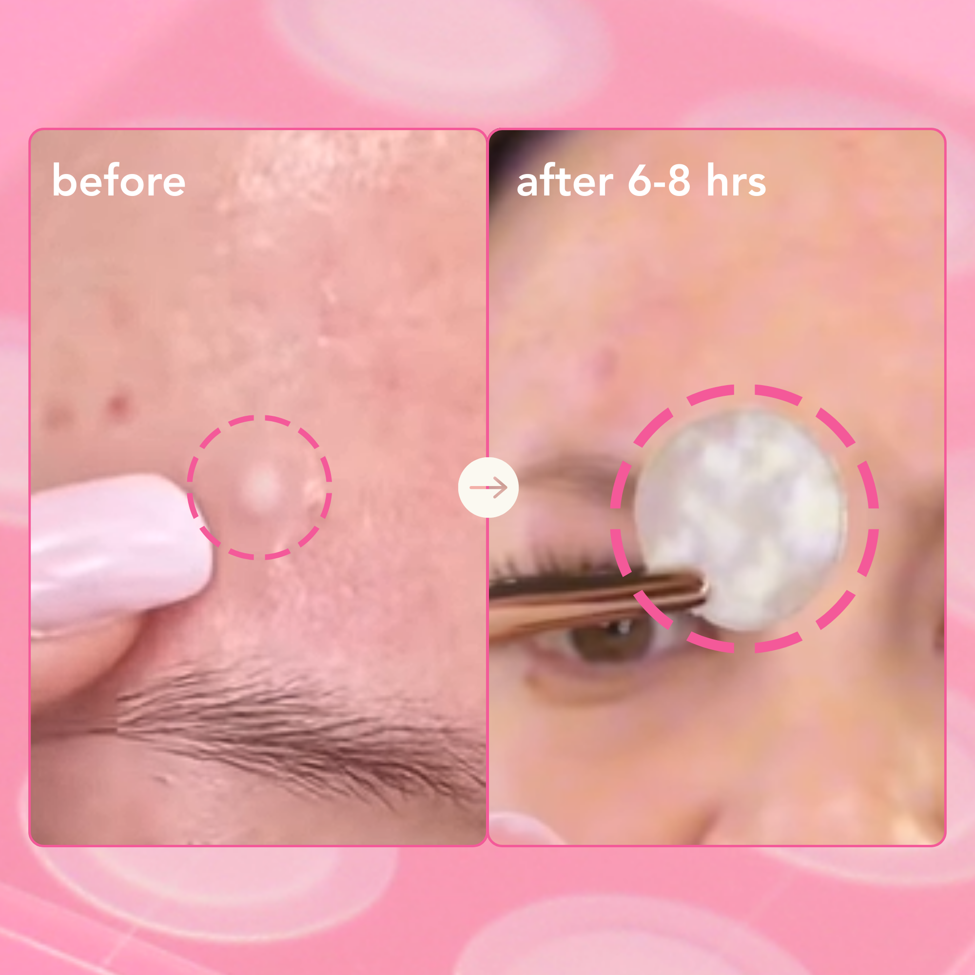 Don't Pop To Me Blemish Spot Cover Pack